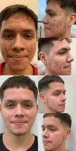 Load image into Gallery viewer, CLEAR SKIN FORMULA (For Acne/Pimples/Whiteheads/Skin Whitening/Pores Tightening, Scars Lightening)