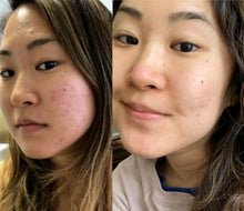 Load image into Gallery viewer, CLEAR SKIN FORMULA (For Acne/Pimples/Whiteheads/Skin Whitening/Pores Tightening, Scars Lightening)