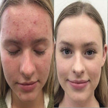 Load image into Gallery viewer, CLear Skin Formula